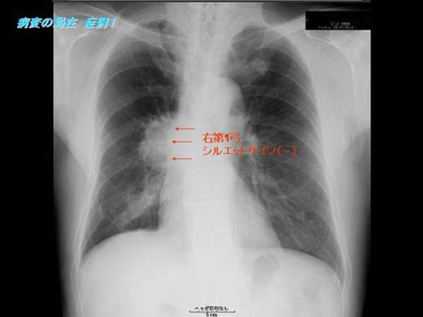 胸部MRIアトラス | 北村 諭, 坂東 政司, 古瀬 信 |本 | 通販