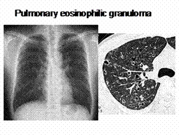 胸部CTの実際と読影